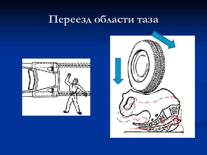 Переезд области таза 