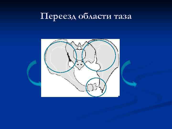 Переезд области таза 