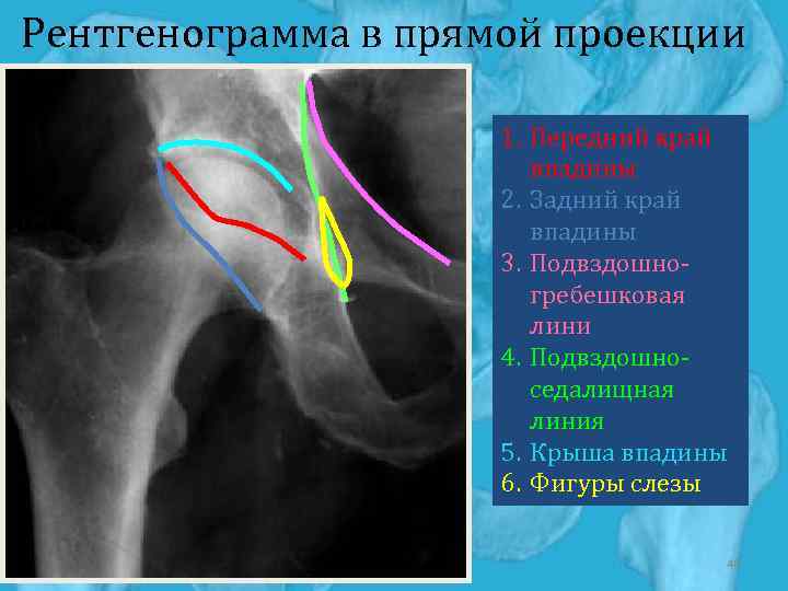 Рентгенография в двух проекциях. Фигура слезы тазобедренный сустав на рентгенограмме. Фигура полумесяца на рентгенограмме тазобедренного сустава. Фигура полумесяца тазобедренный сустав. Фигура слезы на рентгенограмме.