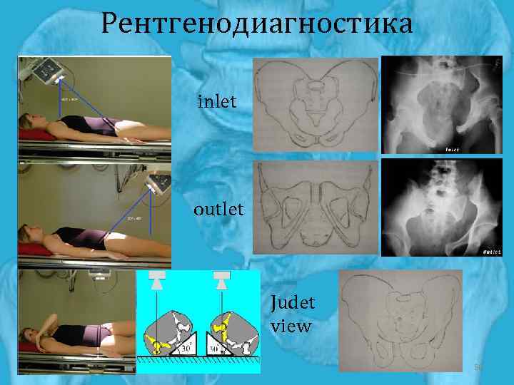 Рентгенодиагностика inlet outlet Judet view 50 