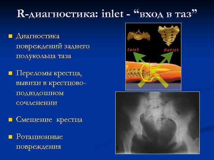 R-диагностика: inlet - “вход в таз” n Диагностика повреждений заднего полукольца таза n Переломы
