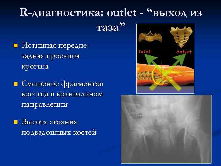 R-диагностика: outlet - “выход из таза” n Истинная переднезадняя проекция крестца n Смещение фрагментов