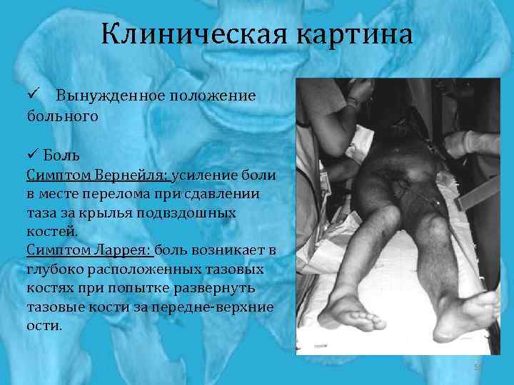 Клиническая картина ü Вынужденное положение больного ü Боль Симптом Вернейля: усиление боли в месте