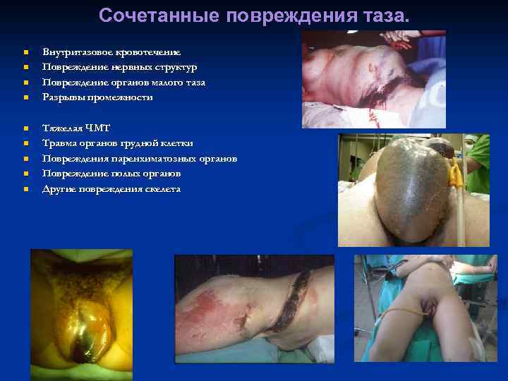 Сочетанные повреждения таза. n n n n n Внутритазовое кровотечение Повреждение нервных структур Повреждение