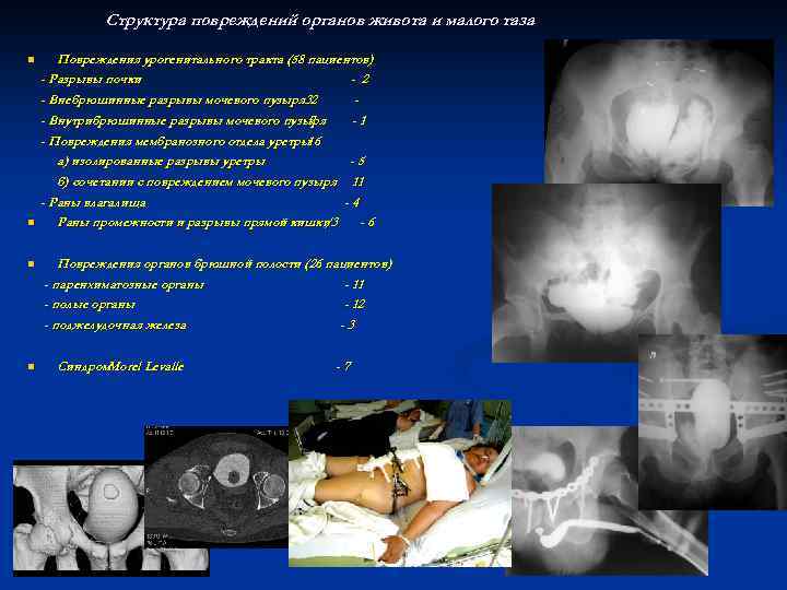 Структура повреждений органов живота и малого таза n n Повреждения урогенитального тракта (58 пациентов)