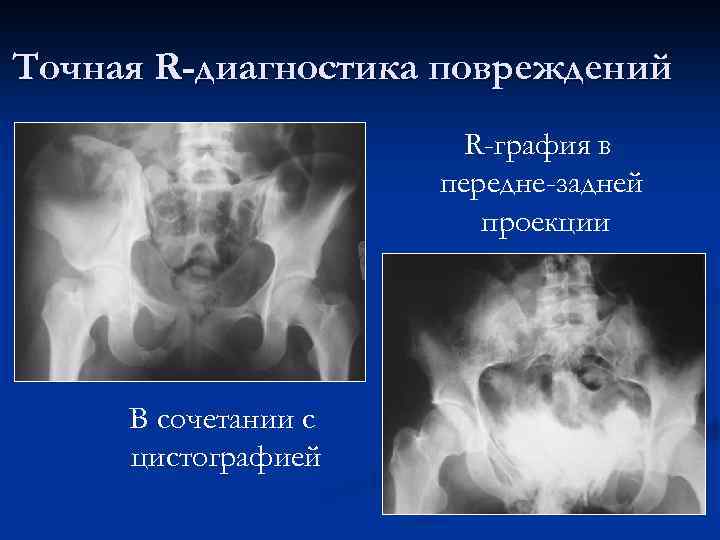 Точная R-диагностика повреждений R-графия в передне-задней проекции В сочетании с цистографией 