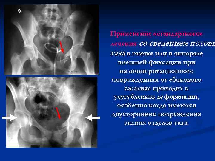 Применение «стандартного» лечения со сведением полови таза в гамаке или в аппарате внешней фиксации