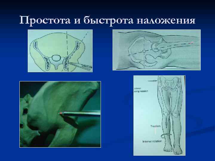 Простота и быстрота наложения 
