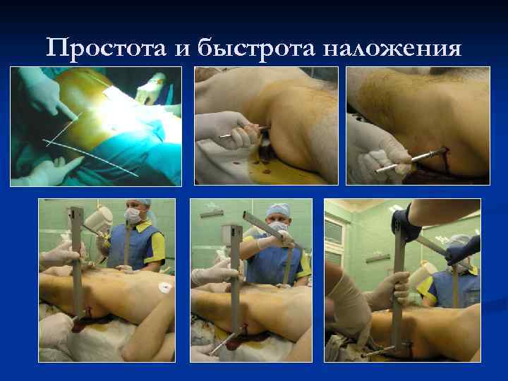 Простота и быстрота наложения 