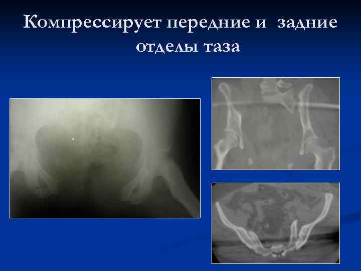 Компрессирует передние и задние отделы таза 