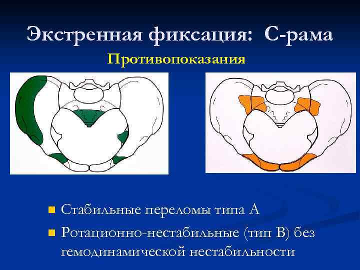 Экстренная фиксация: С-рама Противопоказания n n Стабильные переломы типа А Ротационно-нестабильные (тип В) без