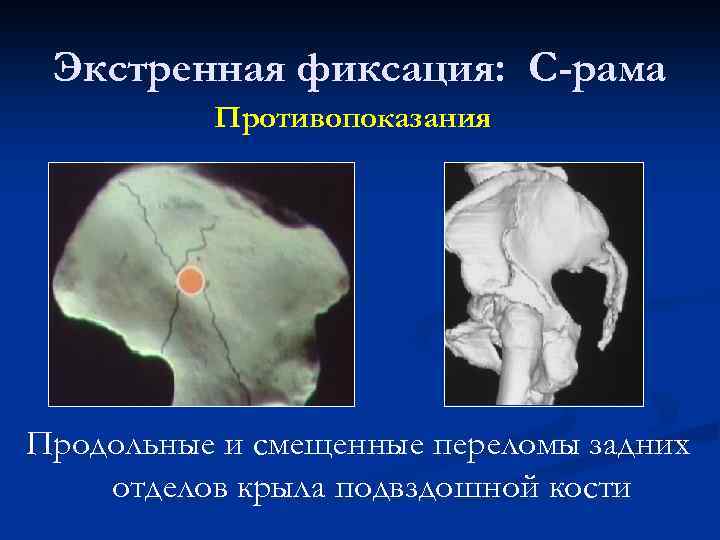 Экстренная фиксация: С-рама Противопоказания Продольные и смещенные переломы задних отделов крыла подвздошной кости 