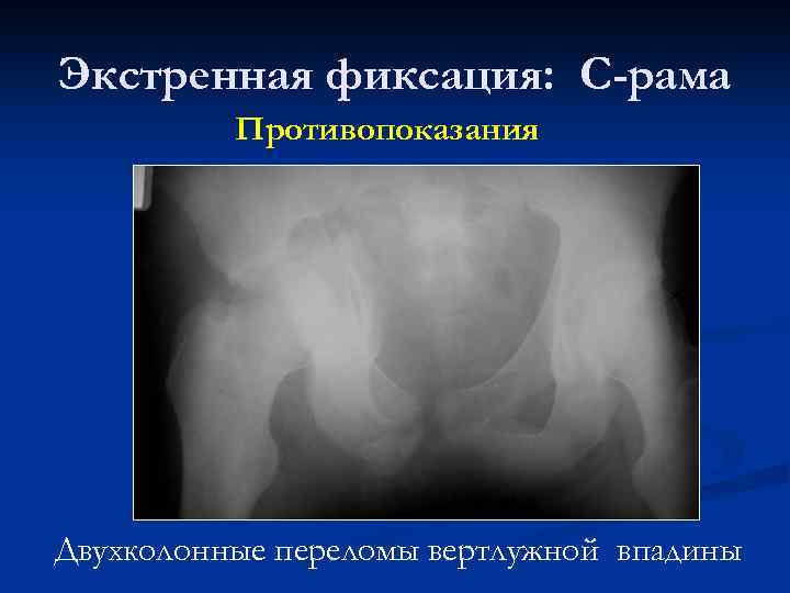 Экстренная фиксация: С-рама Противопоказания Двухколонные переломы вертлужной впадины 