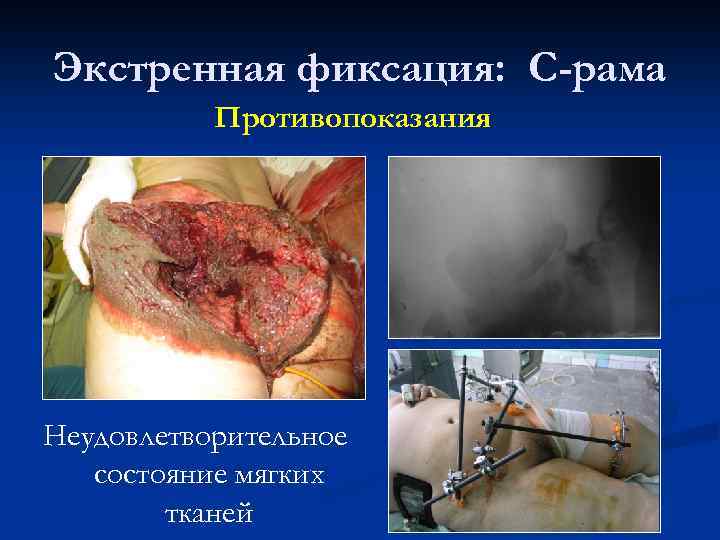 Экстренная фиксация: С-рама Противопоказания Неудовлетворительное состояние мягких тканей 