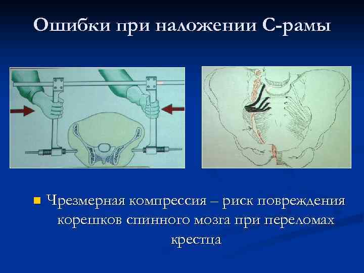 Ошибки при наложении С-рамы n Чрезмерная компрессия – риск повреждения корешков спинного мозга при