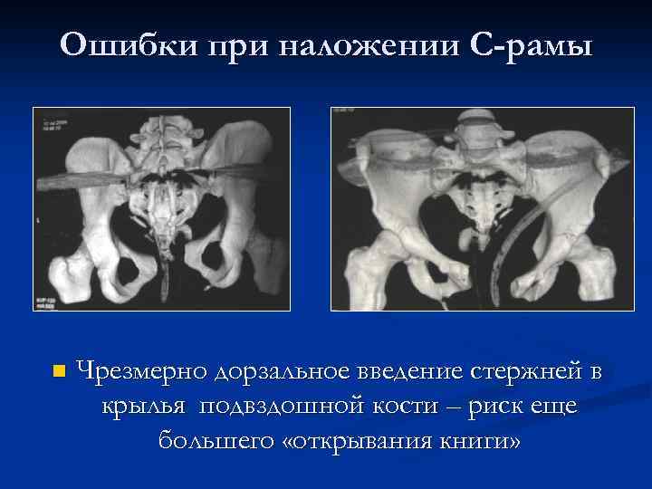 Ошибки при наложении С-рамы n Чрезмерно дорзальное введение стержней в крылья подвздошной кости –