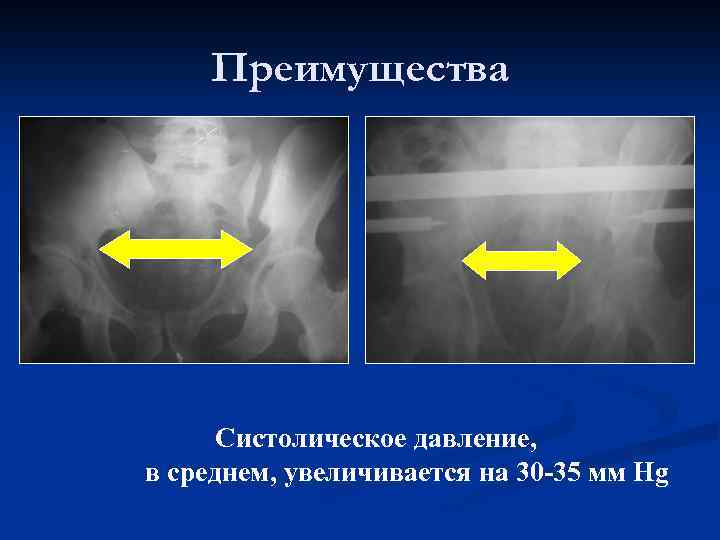 Преимущества Систолическое давление, в среднем, увеличивается на 30 -35 мм Hg 