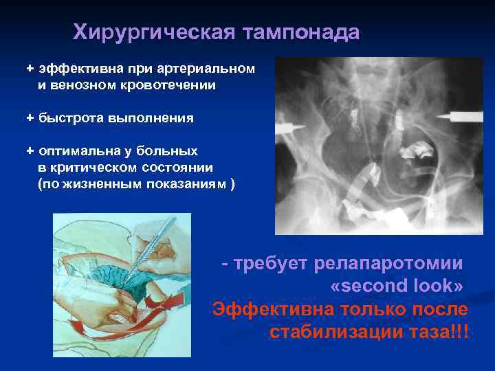 Хирургическая тампонада + эффективна при артериальном и венозном кровотечении + быстрота выполнения + оптимальна