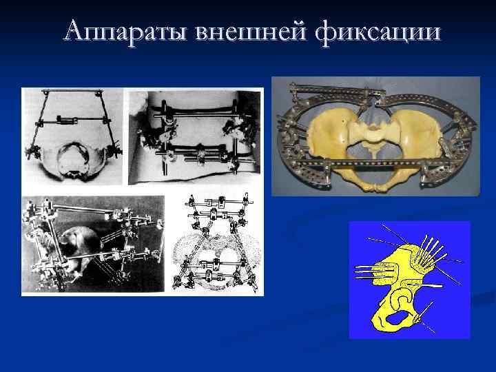 Аппараты внешней фиксации 