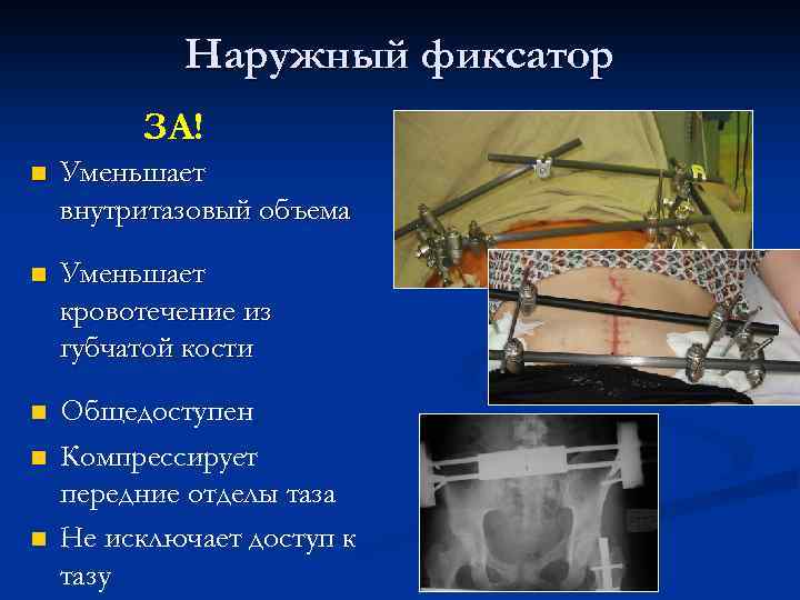 Наружный фиксатор ЗА! n Уменьшает внутритазовый объема n Уменьшает кровотечение из губчатой кости n