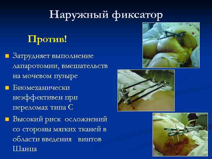Наружный фиксатор Против! n n n Затрудняет выполнение лапаротомии, вмешательств на мочевом пузыре Биомеханически