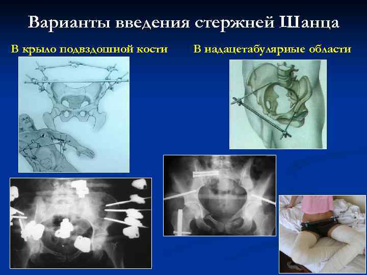Варианты введения стержней Шанца В крыло подвздошной кости В надацетабулярные области 