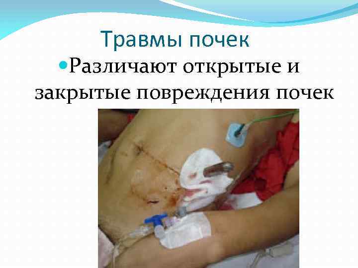 Травмы почек Различают открытые и закрытые повреждения почек 