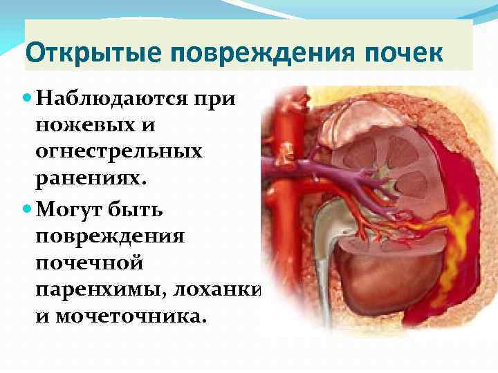 Открытые повреждения почек Наблюдаются при ножевых и огнестрельных ранениях. Могут быть повреждения почечной паренхимы,