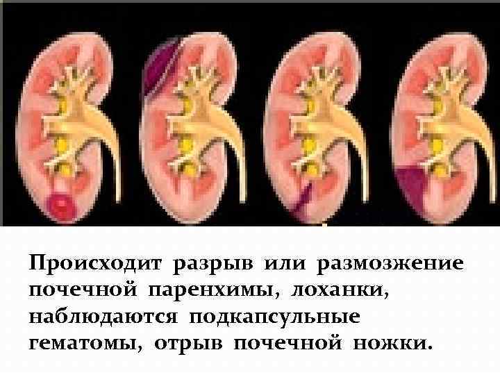 Происходит разрыв или размозжение почечной паренхимы, лоханки, наблюдаются подкапсульные гематомы, отрыв почечной ножки. 