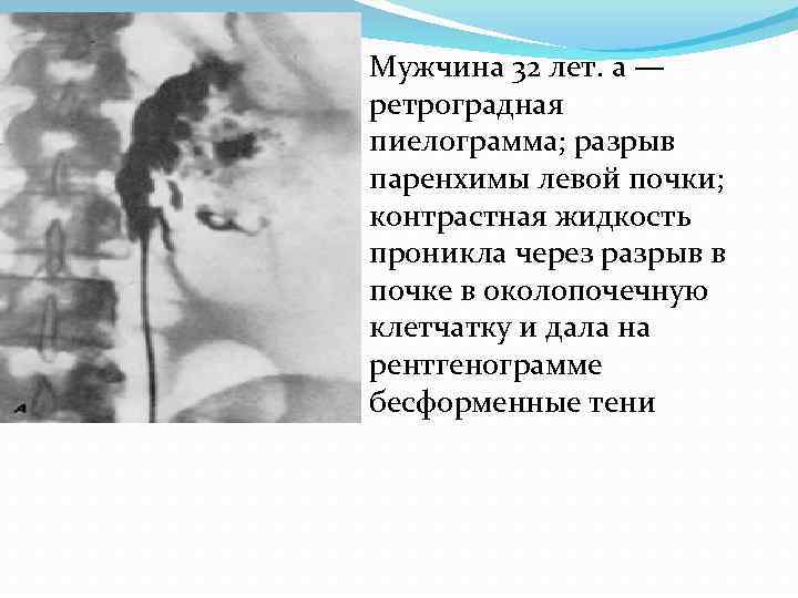 Мужчина 32 лет. а — ретроградная пиелограмма; разрыв паренхимы левой почки; контрастная жидкость проникла