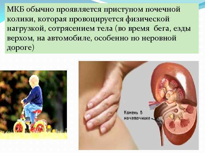 МКБ обычно проявляется приступом почечной колики, которая провоцируется физической нагрузкой, сотрясением тела (во время