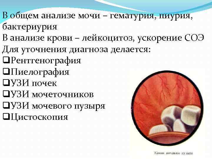 В общем анализе мочи – гематурия, пиурия, бактериурия В анализе крови – лейкоцитоз, ускорение
