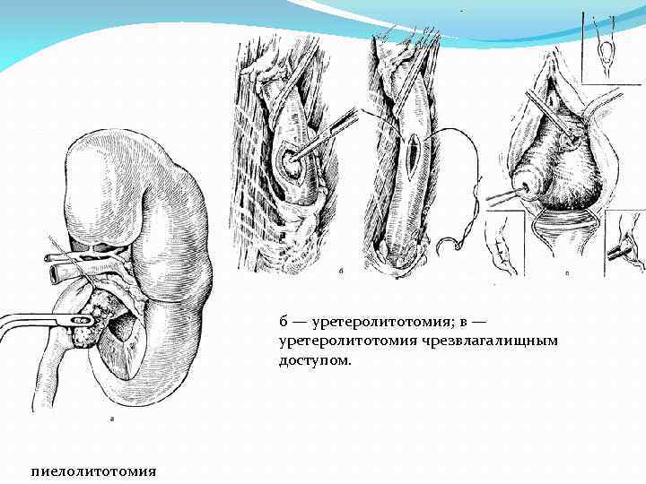 б — уретеролитотомия; в — уретеролитотомия чрезвлагалищным доступом. пиелолитотомия 