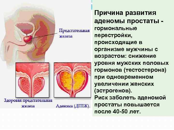 Аденома простаты у мужчин симптомы и лечение. Аденома предстательной железы причины.