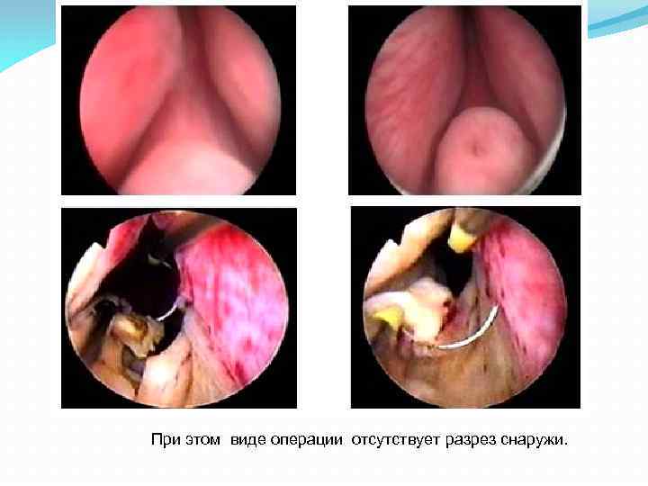  При этом виде операции отсутствует разрез снаружи. 