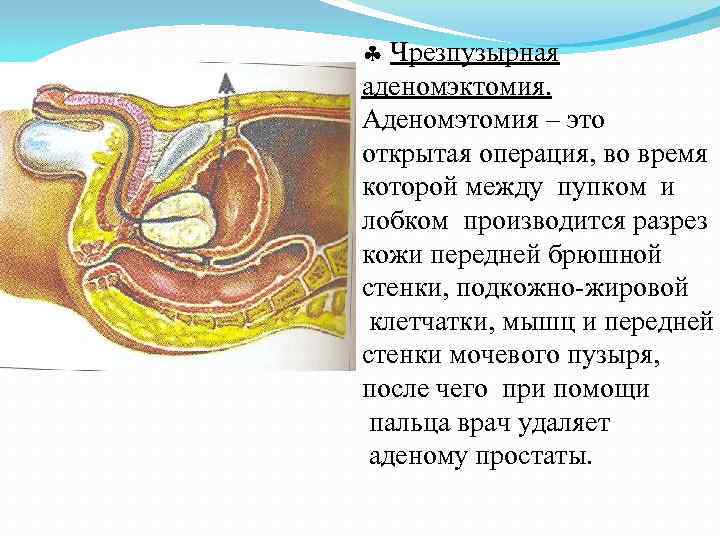  Чрезпузырная аденомэктомия. Аденомэтомия – это открытая операция, во время которой между пупком и