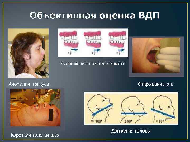 Объективная оценка ВДП Выдвижение нижней челюсти Аномалия прикуса Короткая толстая шея Открывание рта Движения