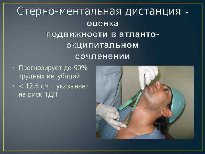 Стерно-ментальная дистанция оценка подвижности в атлантоокципитальном сочленении • Прогнозирует до 90% трудных интубаций •