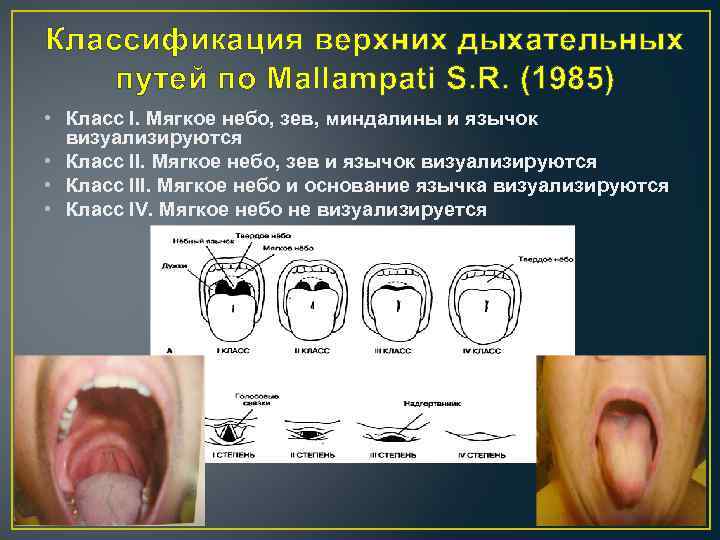 Классификация верхних дыхательных путей по Mallampati S. R. (1985) • Класс I. Мягкое небо,