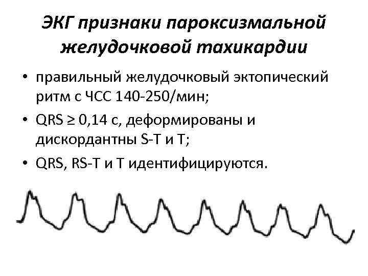 ЭКГ признаки пароксизмальной желудочковой тахикардии • правильный желудочковый эктопический ритм с ЧСС 140 -250/мин;