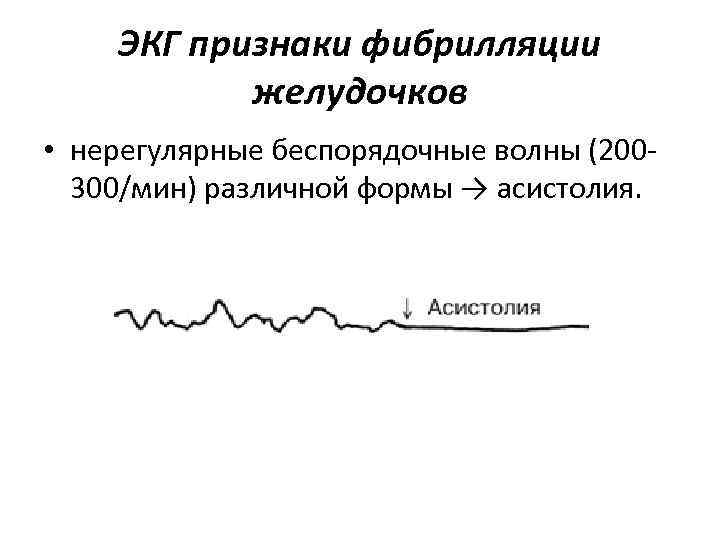 ЭКГ признаки фибрилляции желудочков • нерегулярные беспорядочные волны (200300/мин) различной формы → асистолия. 