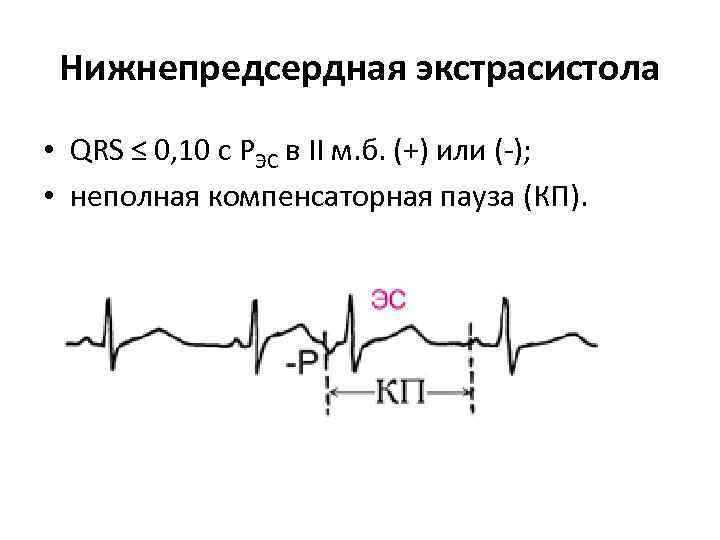 Нижнепредсердная экстрасистола • QRS ≤ 0, 10 с РЭС в II м. б. (+)