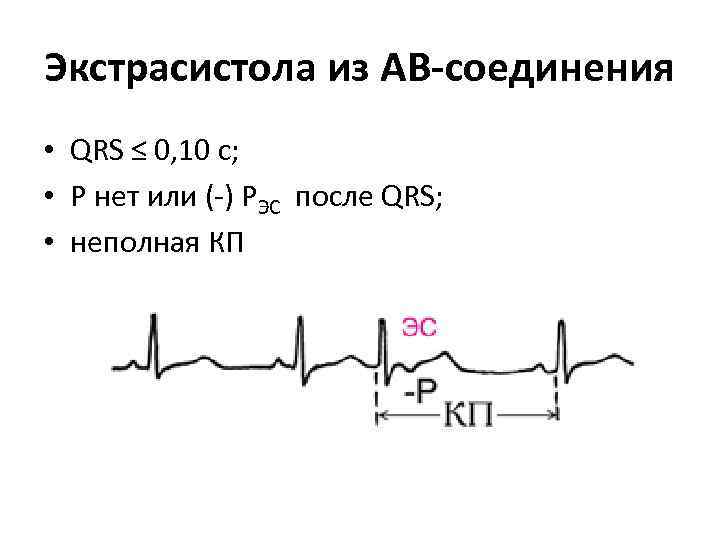 Экстрасистола из АВ-соединения • QRS ≤ 0, 10 с; • Р нет или (-)