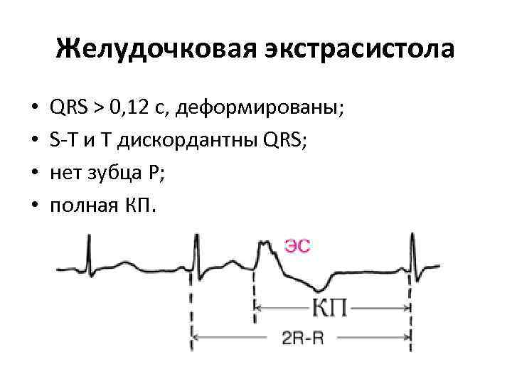 Желудочковая экстрасистола • • QRS > 0, 12 c, деформированы; S-T и Т дискордантны