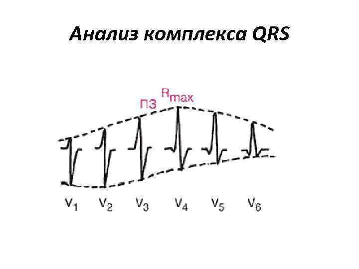 Анализ комплекса QRS 
