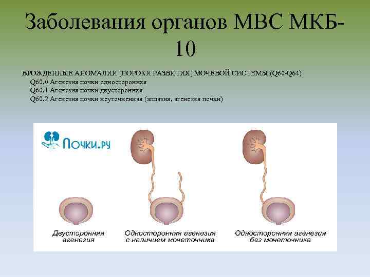 Заболевания органов МВС МКБ 10 ВРОЖДЕННЫЕ АНОМАЛИИ [ПОРОКИ РАЗВИТИЯ] МОЧЕВОЙ СИСТЕМЫ (Q 60 -Q