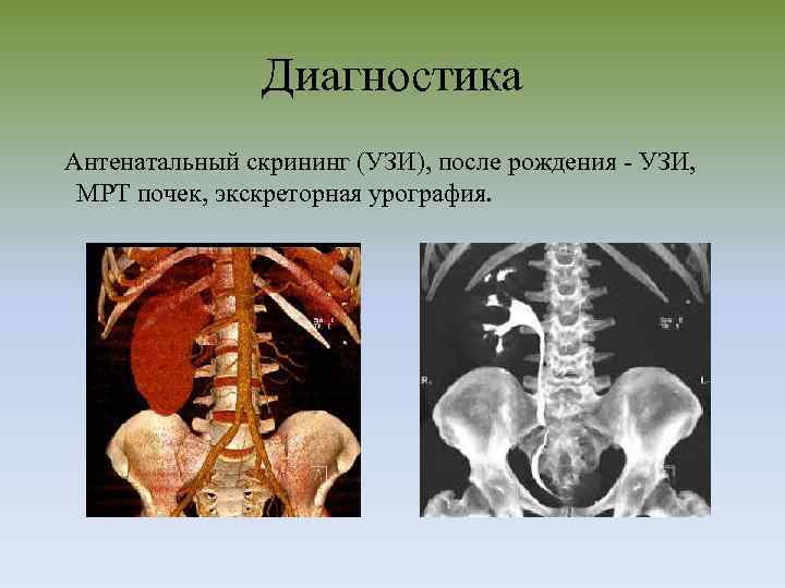 Диагностика Антенатальный скрининг (УЗИ), после рождения - УЗИ, МРТ почек, экскреторная урография. 