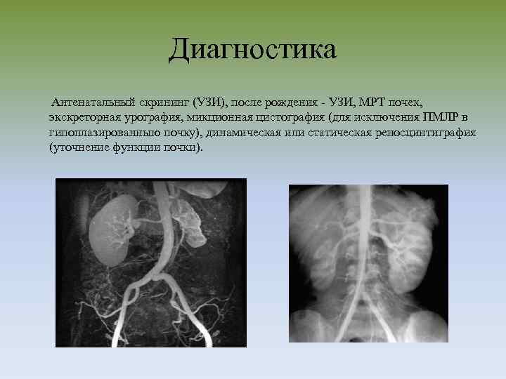 Диагностика Антенатальный скрининг (УЗИ), после рождения - УЗИ, МРТ почек, экскреторная урография, микционная цистография