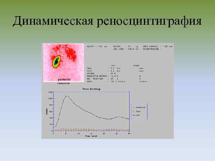 Динамическая реносцинтиграфия 