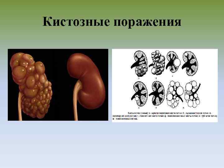 Кистозные поражения 